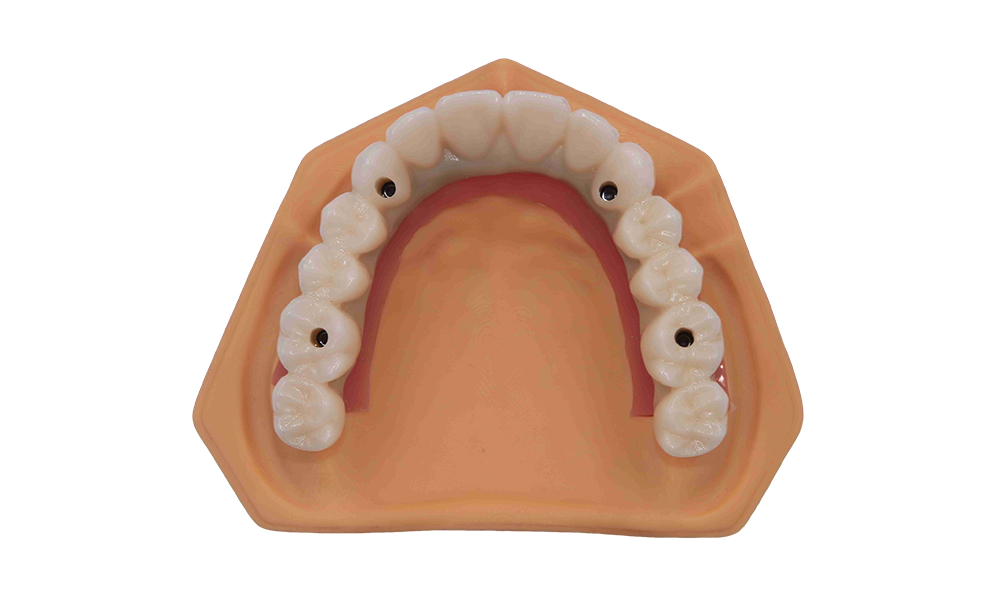 Implant Bridge