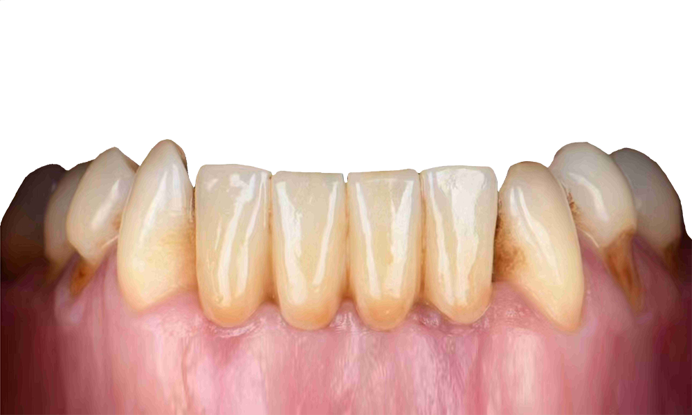 Layered Zirconia