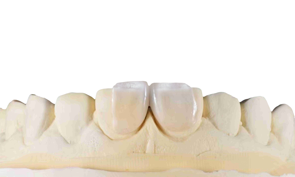 Emax Veneer