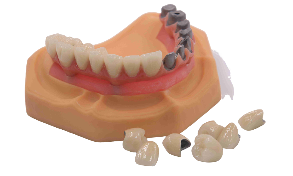 Implant Bridge