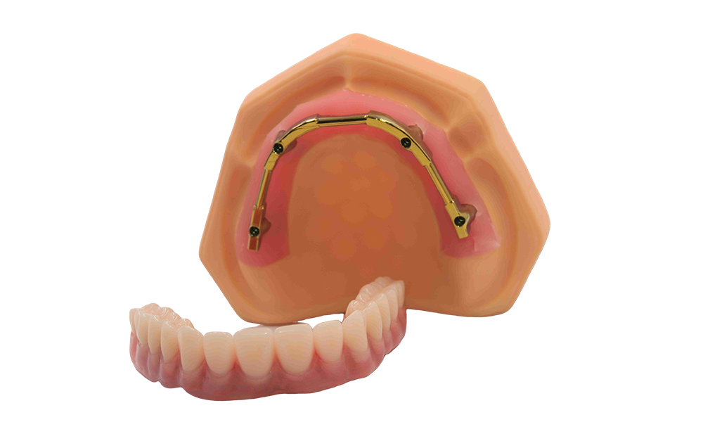 Milled titanium bar with denture