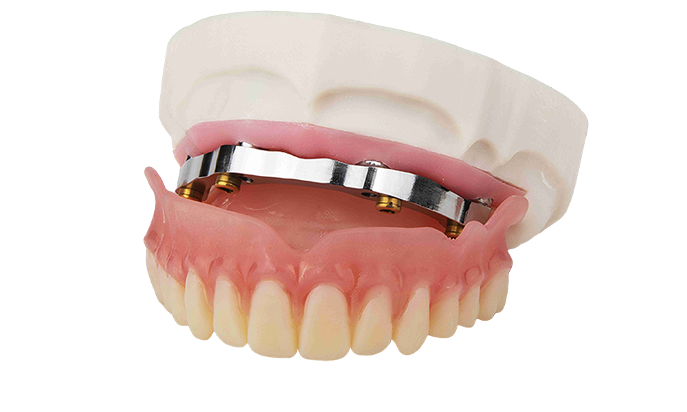 Milled Ti-bar with locator & denture