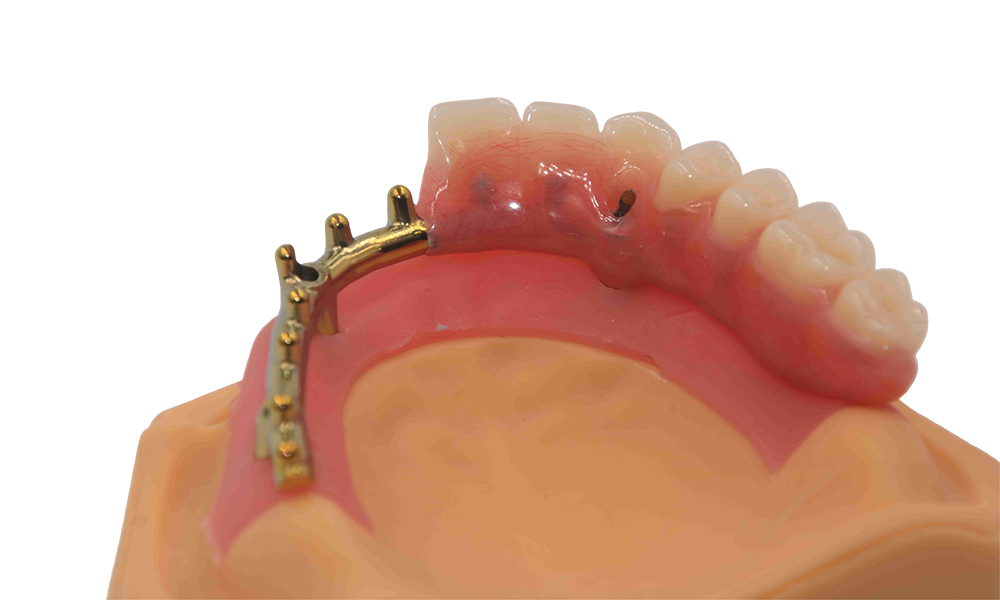 Gold hue Bar with denture