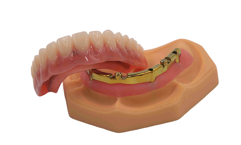 Milled Ti-bar with locator & denture